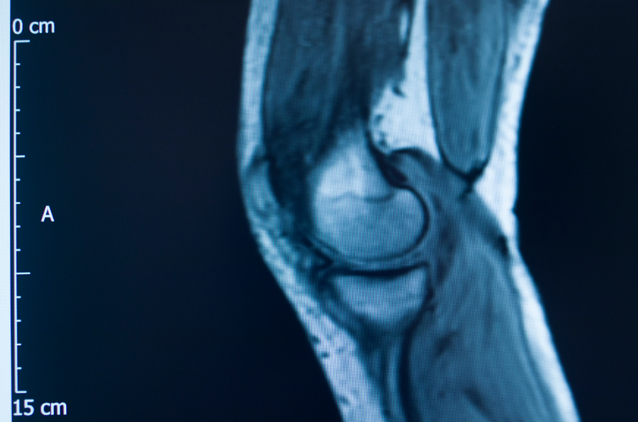 The Surprising Link Between Breast Support and ACL Injury Risk